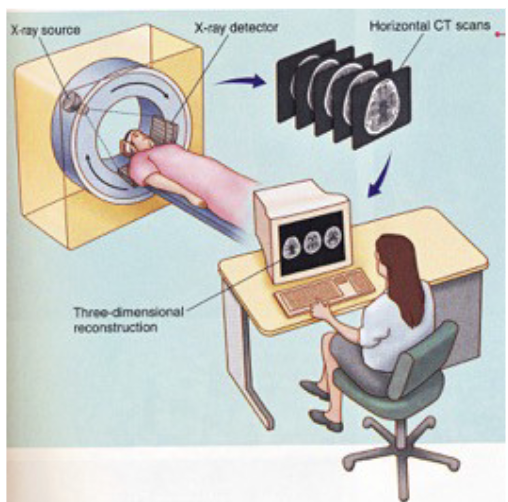 <p>CT → imaging technique that uses x-ray beams (high energy light/radiation)</p><ul><li><p>Patients lie in a cylindrical x-ray source to get images of their body at all angles, 360°</p></li><li><p>Following scanning, x-ray detections are computerized and reconstructed into a 3D model of the patient’s body</p><p></p></li><li><p>CT scans are cheap and fast, but not the best for soft tissue (like the brain)</p></li><li><p>Sometimes contrast agents (fluids like iodine) are administered to improve resolution</p></li></ul><p></p>