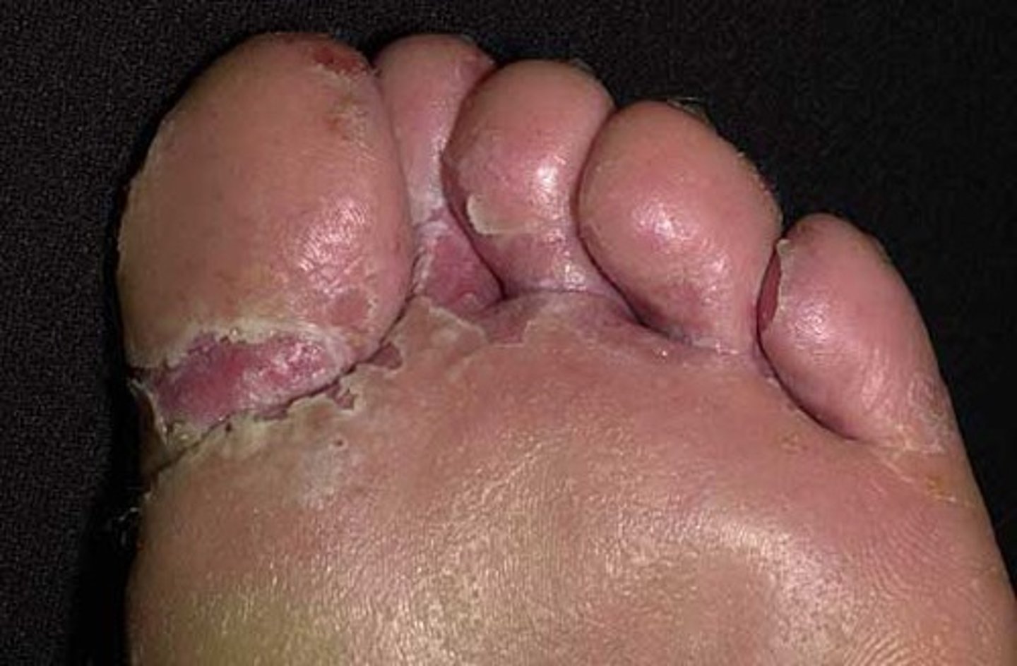 <p>athlete's foot; on the feet and between the toes</p>