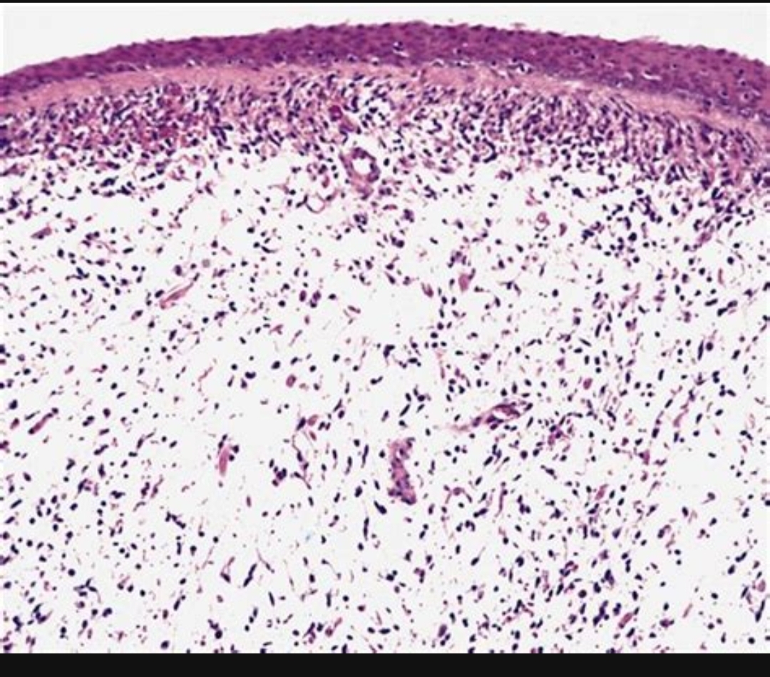 <p>1) Diagnostic </p><p>2) clinique (population, zones)</p><p>3) histology </p><p>4) dd</p>