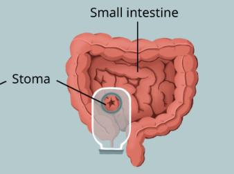 <p><strong>surgically created opening in the abdomen in which a piece of the ileum (small intestine) is brought through the abdominal wall to create a stoma</strong><br>-sections of small intestine and large intestine have been removed or require bypass<br>-<strong>liquid waste with digestive enzymes can be corrosive to adjacent skin</strong></p><p><strong><u>Temporary</u></strong>: may be required when a surgical site lower in the digestive tract needs time to heal; “loop stoma”<br><strong><u>Permanent</u></strong>: may be required when the <strong>large intestine is removed </strong>and reconnection to the anus isn’t feasible; “end stoma”</p>