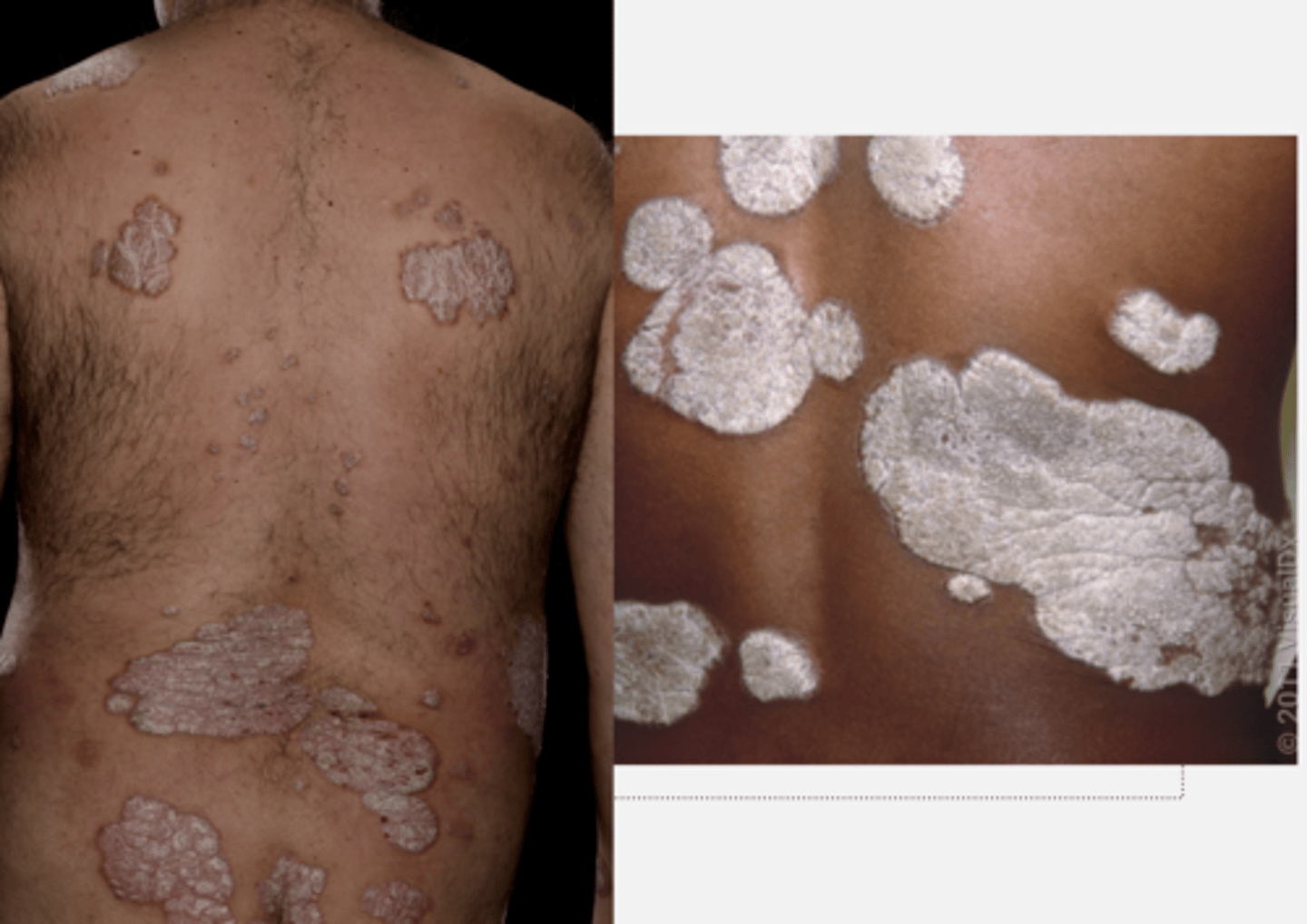 <p>Chronic plaque psoriasis- </p><p>- commonest type </p><p>- symmetrical plaques on the extensor surfaces of the limbs (knees + elbows), scalp and lower back.</p><p>- well defined</p><p>Flexural (inverse) psoriasis- </p><p>- smooth, erythematous plaques without scale in flexures and skin folds.</p><p>Guttate psoriasis- </p><p>- multiple small, tear-drop shaped, erythematous plaques occur on the trunk after a Streptococcal infection in young adults.</p><p>Pustular psoriasis- </p><p>- multiple petechiae and pustules on the palms and soles.</p><p>Generalised/erythrodermic psoriasis</p><p>- rare but serious form characterised by erythroderma and systemic illness</p>