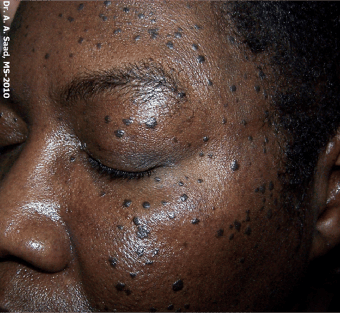 <p>seborrheic keratosis</p>