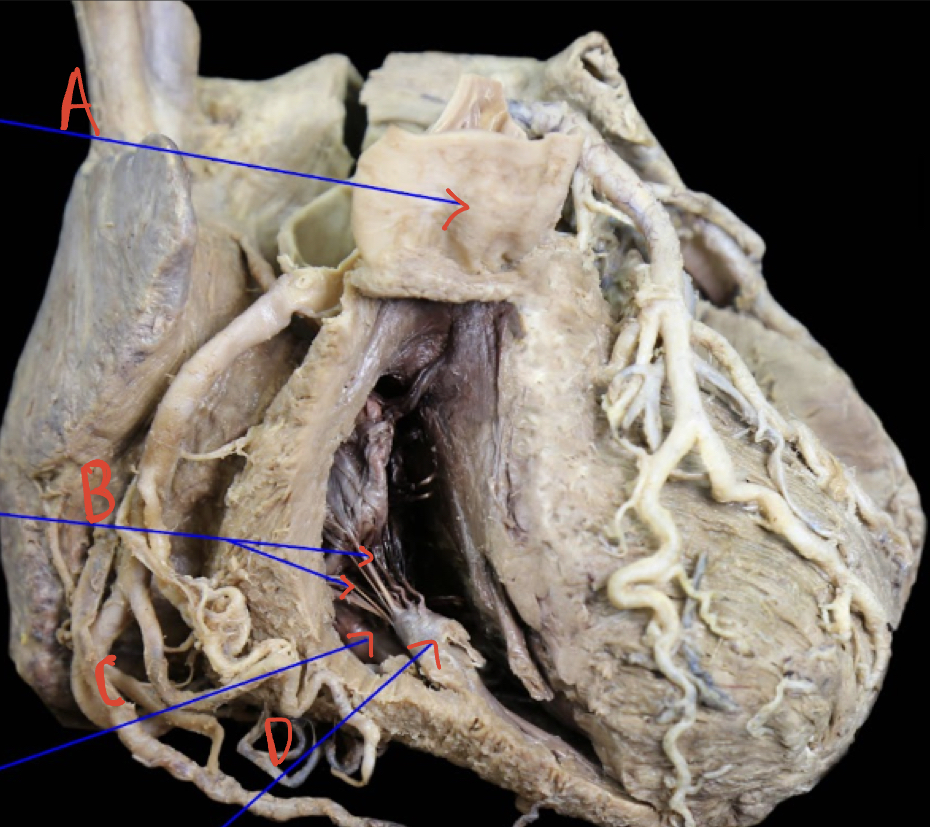 Right ventricle internal anterior 
