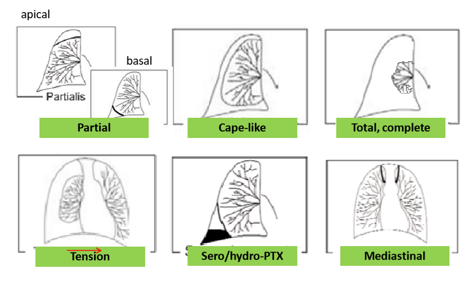 <ul><li><p>partial- apical, basal</p></li><li><p>cape like</p></li><li><p>complete</p></li><li><p>tension</p></li><li><p>sero/ hydro PTX</p></li><li><p>mediastinal</p></li></ul><p></p>