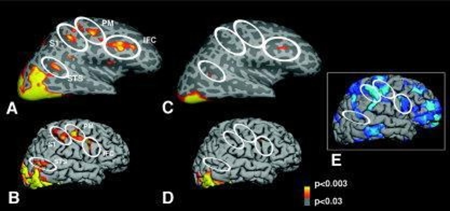 <p>It indicates that areas of the brain associated with social cognition, including parts of the MNS, show more widespread thinning in individuals with autism.</p>