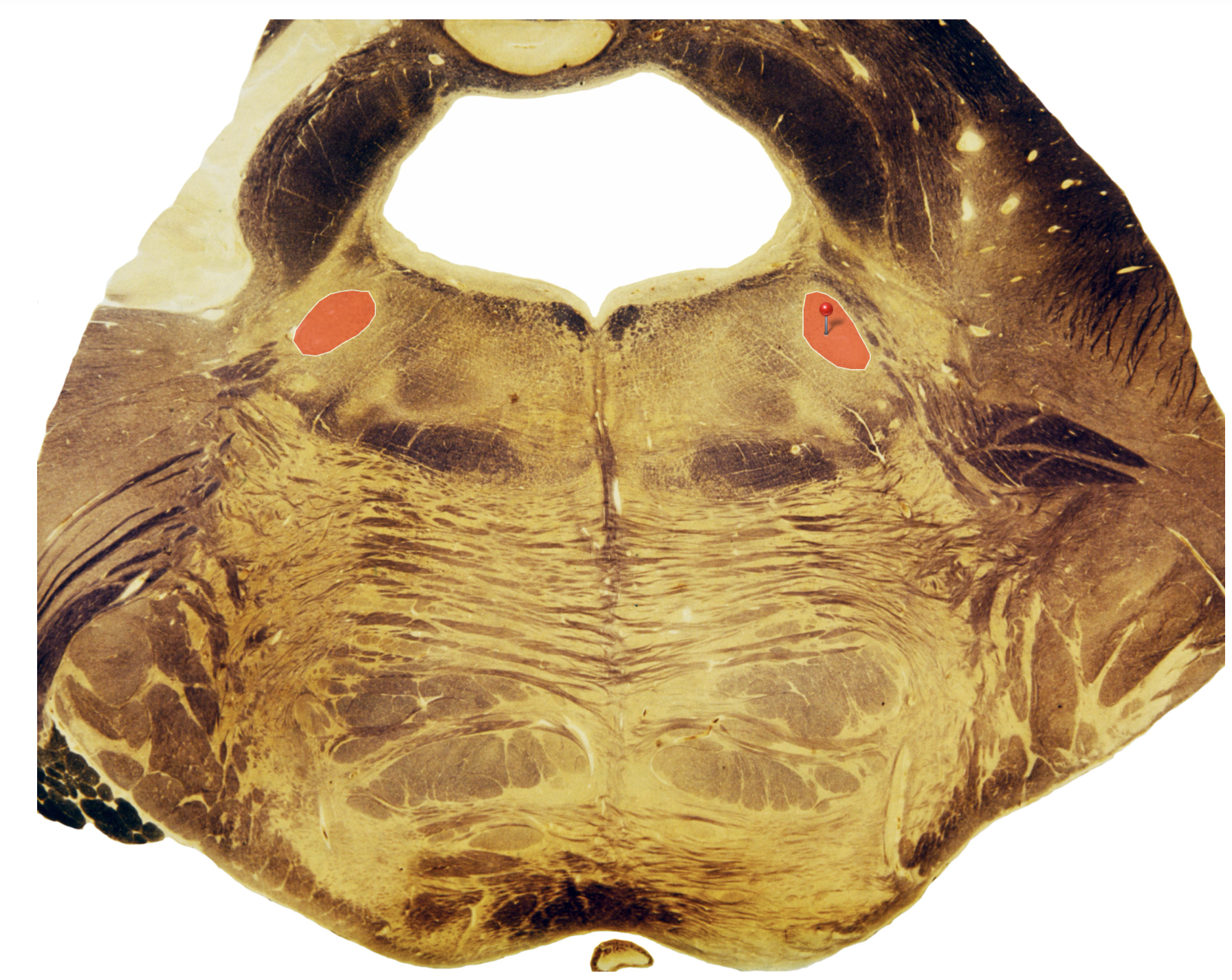 <p>Trigeminal Motor Nucleus</p>