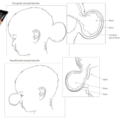 <p>Type of NTDs</p><p><strong>• Disturbance in separation of surface ectoderm and neuroectoderm during final phase of neural tube formation = Protrusion of brain and/or meninges through an opening in the calvaria.</strong></p><ul><li><p>Since neuroectoderm and non-neural ectoderm cannot separate</p></li><li><p>This can be disturbed at any of the sites of neural tube closure.</p></li><li><p><strong>Meningocele:</strong> protrusion of meninges, covered by skin through the skull</p></li><li><p><strong>Meningoencephalocele:</strong> as above but contains brain parenchyma in the protrusion (Far more severe)</p></li><li><p>Size variation</p></li></ul><p></p>