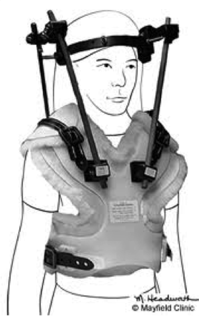 <p>Frame apparatus for cervical fractures; four pins inserted in skull attached to metal ring and then to body frames</p>