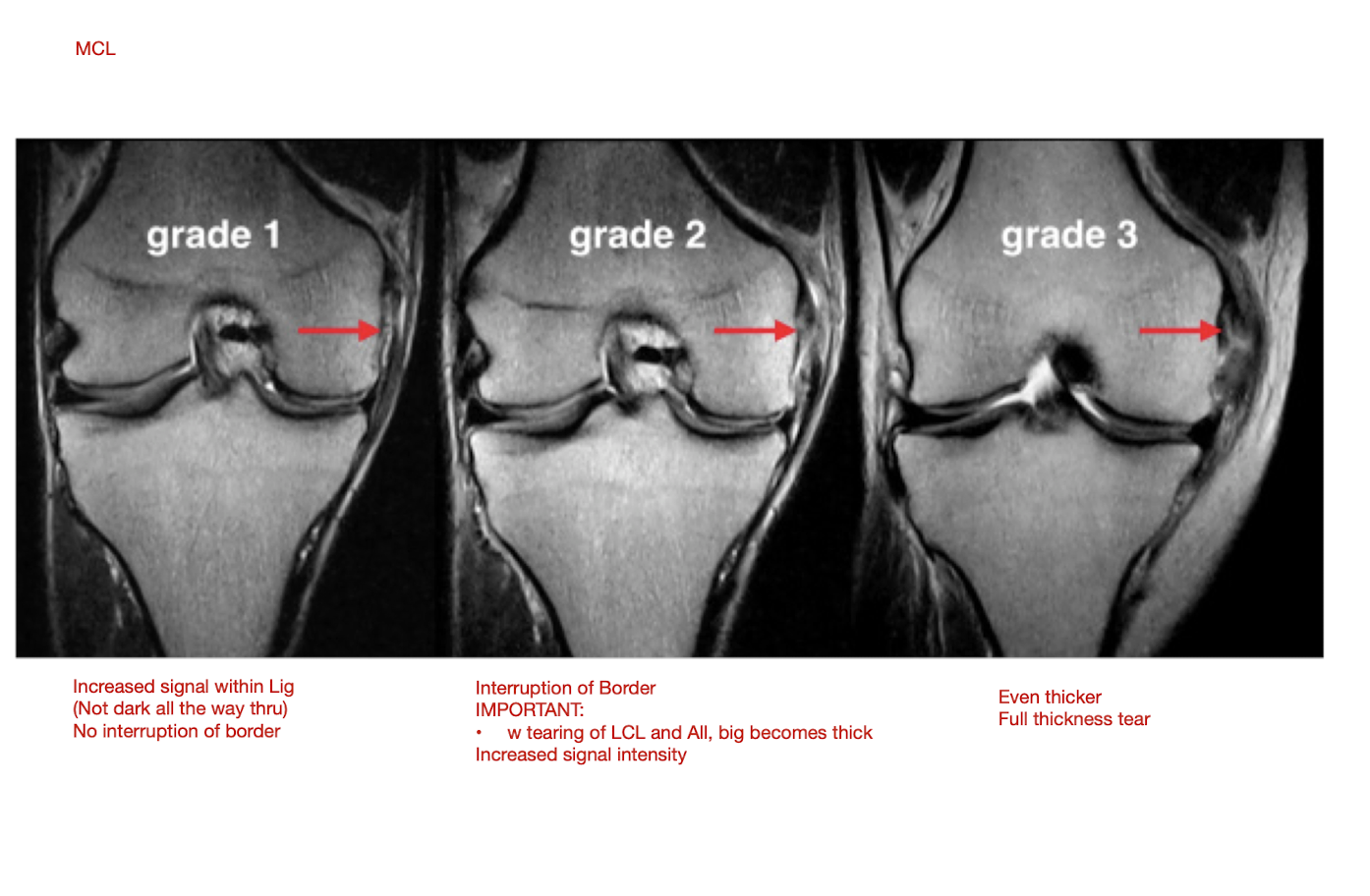 <p>MCL Pathology: MOI</p><ul><li><p>2 main MOI</p></li></ul><p></p><p></p>