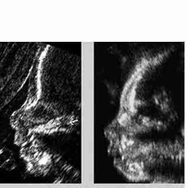 <p>A sloping forehead is typical of microceph</p>