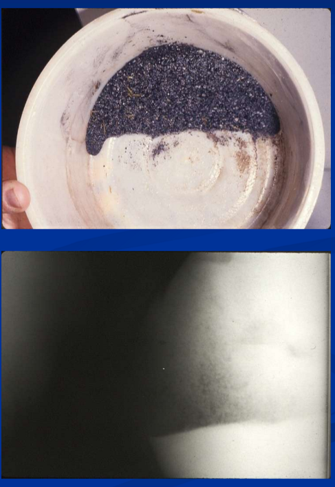 <ul><li><p><strong>sandy environments, </strong>bare pastures, <strong>feeding hay on the ground </strong>are predispositions to sand accumulation in LI </p></li><li><p>sand irritates the colonic mucosa </p><ul><li><p>sometimes resulting in intermittent diarrhea (<strong>sand colopathy) </strong></p></li></ul></li><li><p>tends to <strong>accumulate in the RDC, </strong>resulting in </p><ul><li><p><strong>abdominal pain </strong>from tension on mesentery, large colon impaction and or obstruction of transverse colon </p></li><li><p>also predisposes to displacement, torsion / volvulus </p></li></ul></li><li><p>diagnosis by </p><ul><li><p><strong>history </strong>of exposure, characteristic sounds on <strong>auscultation, </strong>detection of excessive <strong>sand in feces, abdominal ultrasound / </strong>radiography, and inadvertent enterocoentesis </p></li></ul></li><li><p><strong>medical tx: psyllium hydromucilloid </strong></p><ul><li><p>400g/500kg in feed or via NG </p></li><li><p>protocol depends on amount of sand, clinical signs (colic or not) </p></li><li><p><strong>IV fluids and analgesics as necessary </strong></p></li></ul></li><li><p><strong>may require celiotomy; large sand accumulations, obstruction at transverse colon, failure of medical management; evacuation of sand via PF enterotomy </strong></p></li><li><p><strong>prevention: </strong>husbandry-avoid feeding on the ground; intermittent feeding of psyllium </p></li></ul><p></p>