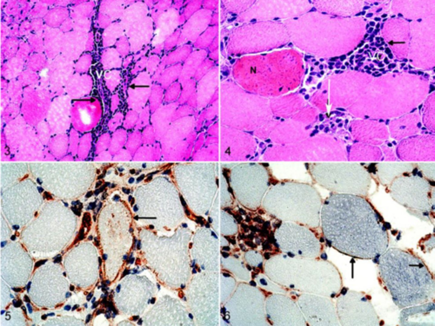 <p>What stain is used to see streptococcal associated rhabdomyolysis and muscle atrophy</p>