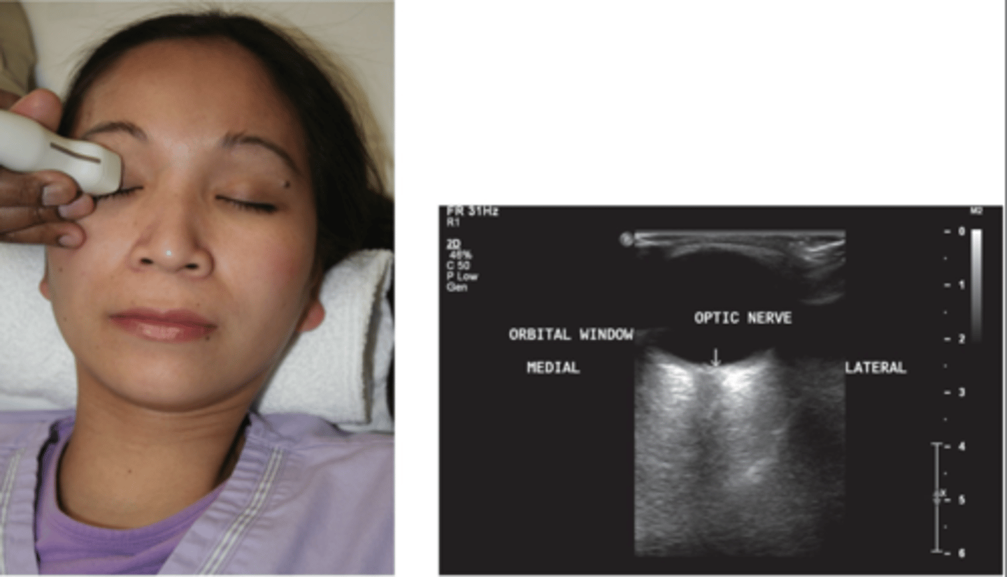 <p>Through orbital place, optic canal, and superior orbital fissure</p>