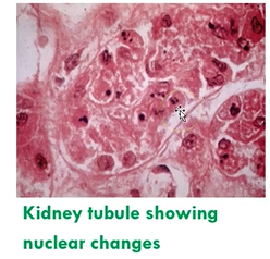 <ol><li><p>pyknosis: nucleus shrinks and condenses</p></li><li><p>karyorrhexis: nucleus fragments</p></li><li><p>karyolysis: nuclear fragments dissolve away</p></li></ol><p></p>