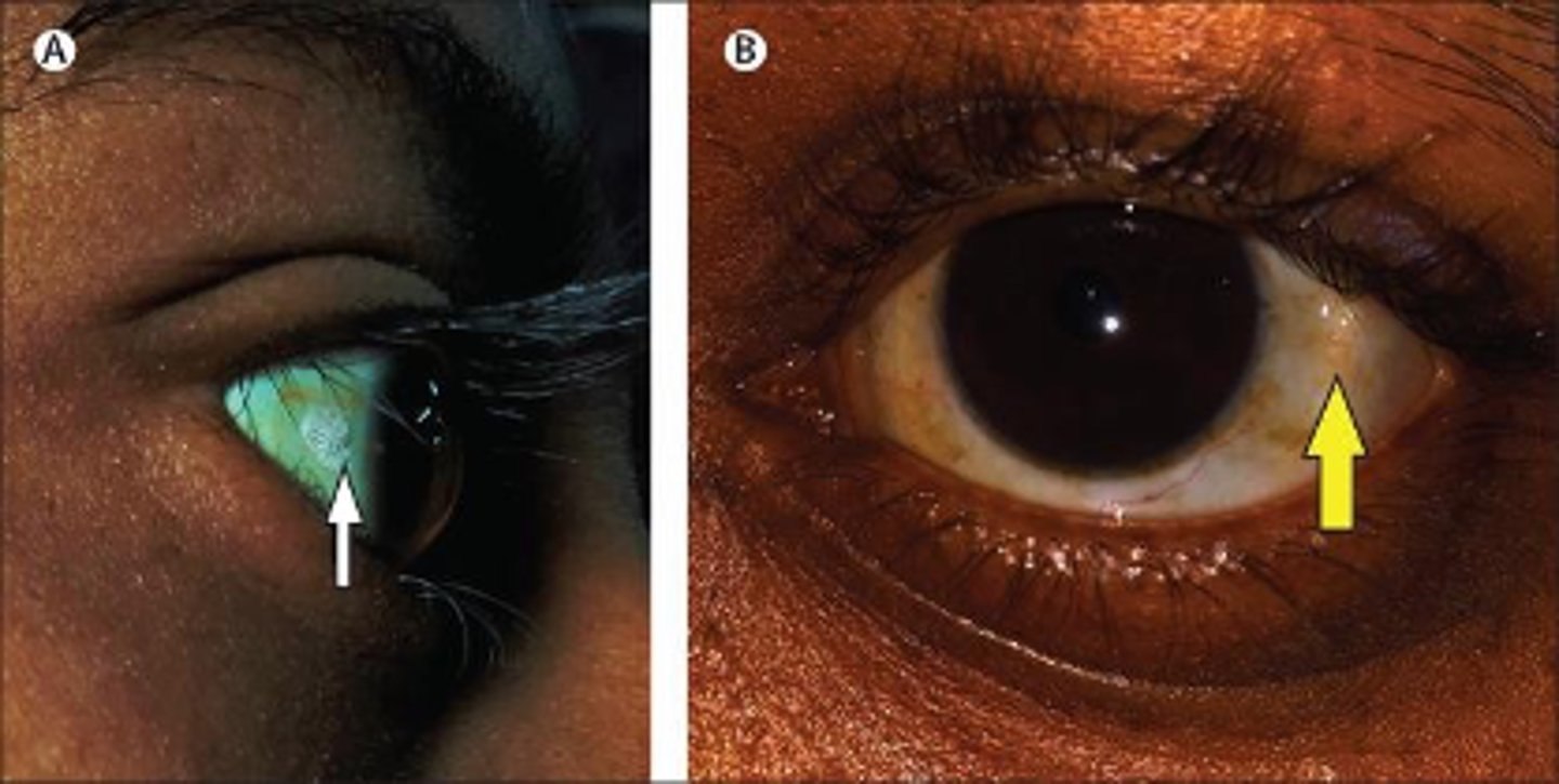 <p>deficiency in this vitamin is associated with night blindness, xerophthalmia (dry eyes) and Bitot spots:</p>