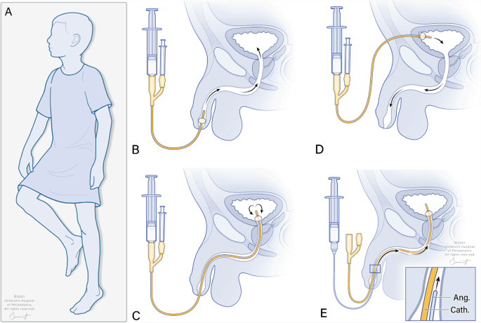 <p>Exams of urinary bladder after introducing contrast into bladder with a cath passing through urethra</p>
