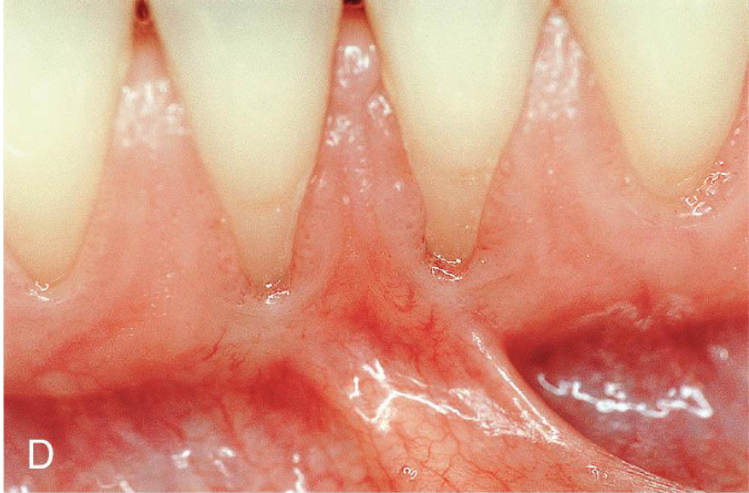 <p><strong>Recession: </strong>an apical shift of the GM caused by different conditions and pathologies</p><ul><li><p>associated with <strong>clinical attachment loss</strong></p></li><li><p>can apply to all surfaces (buccal/lingual/interprox.)</p></li><li><p><strong>tendency to increase with age</strong></p><ul><li><p>88% of people aged ≥ 65 years</p></li><li><p>50% of people aged 18-64</p></li></ul></li><li><p>occurs in populations with both high and low standards of oral hygiene</p></li></ul><p>.</p><p><strong>Consequences of Recession/Root Exposure:</strong></p><ul><li><p>impaired esthetics</p></li><li><p>dentinal hypersensitivity</p></li><li><p>root caries</p></li><li><p>NCCLs (due to abrasion/erosion)</p></li></ul><p>.</p><p><strong>Features Used to Describe Mucogingival Conditions Involving Gingival Recession:</strong></p><ul><li><p>Interdental CAL</p></li><li><p>Gingival Phenotype (gingival thickness and KTW)</p></li><li><p>Root surface condition (NCCLs, Root Caries)</p></li><li><p>Detection of CEJ</p></li><li><p>Tooth position</p></li><li><p>Aberrant frenum</p></li><li><p>Vestibular Depth</p></li><li><p>Number of adjacent restorations</p></li></ul><p><strong>NOTE: Mucogingival conditions can be present WITHOUT GINGIVAL RECESSION!</strong></p><p></p>
