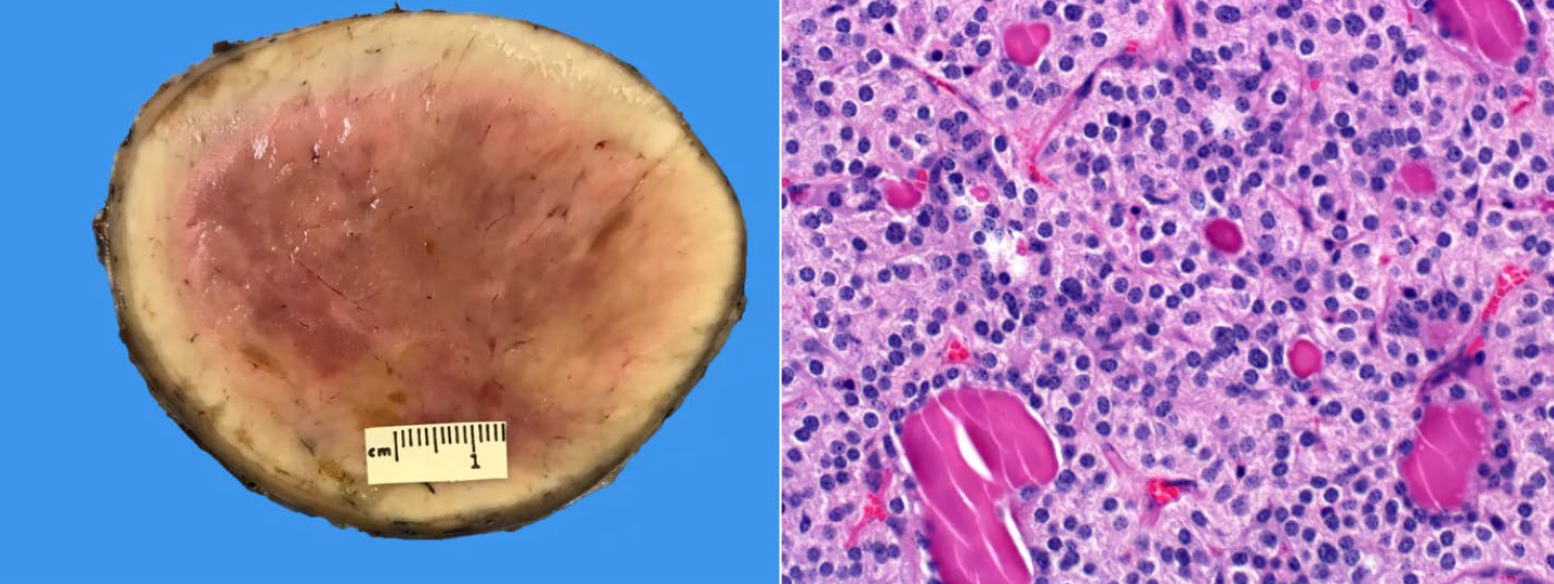 <p>Bull. What is the condition?</p><p>A-C-cell tumor</p><p>B-Adenocarcinoma</p><p>C-Melanoma</p><p>D-Fibroma</p>