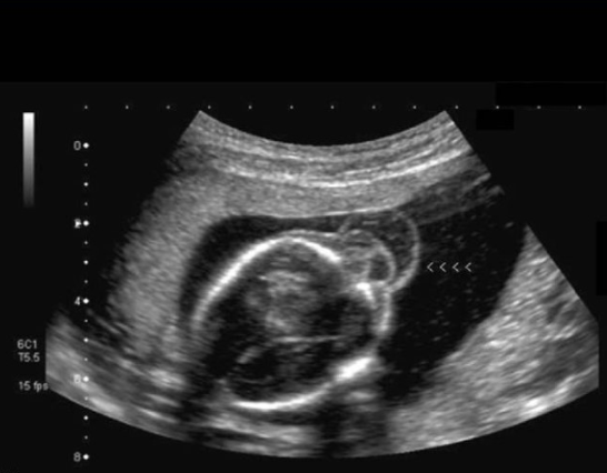 <p>the majority of encephalocele are located in the ___ region of the cranium</p><p>a) occipital</p><p>b) temporal</p><p>c) frontal</p><p>d) parietal </p>
