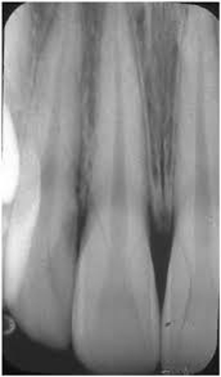 <p>Insufficient vertical angulation.</p>