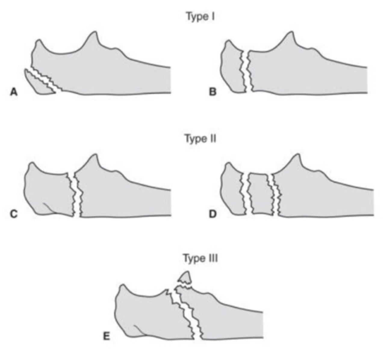 <p>3 types<br>- type 1: proximal 1/3 olecranon<br>- type 2: middle 1/3 olecranon (most common)<br>- type 3: distal 1/3 olecranon (closer to ulnar shaft)</p>