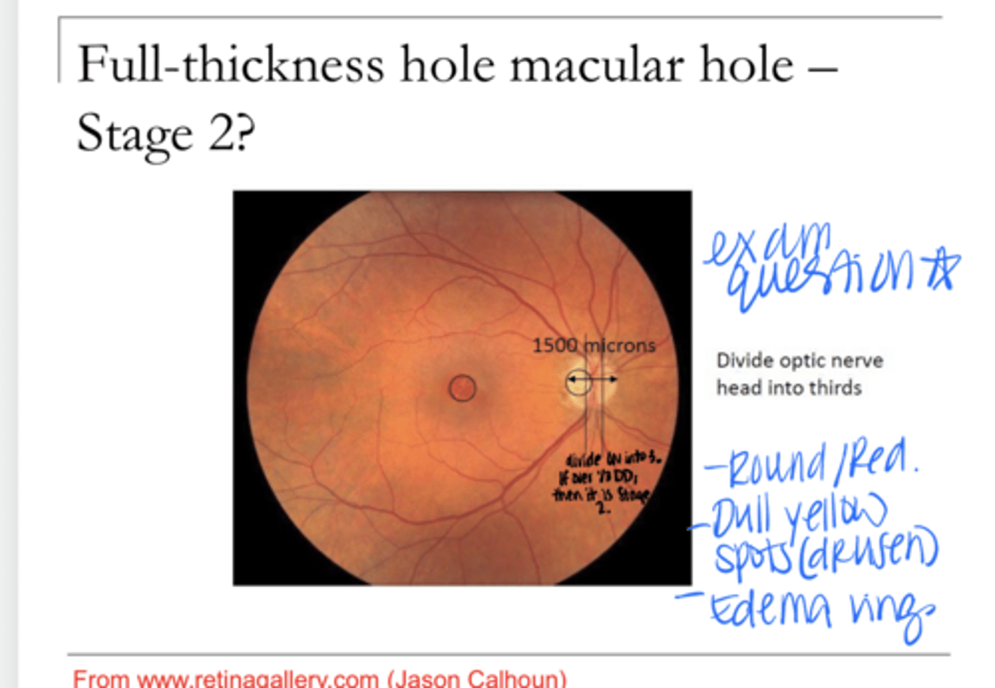 <p>Describe Stage 2 Macular Hole</p>