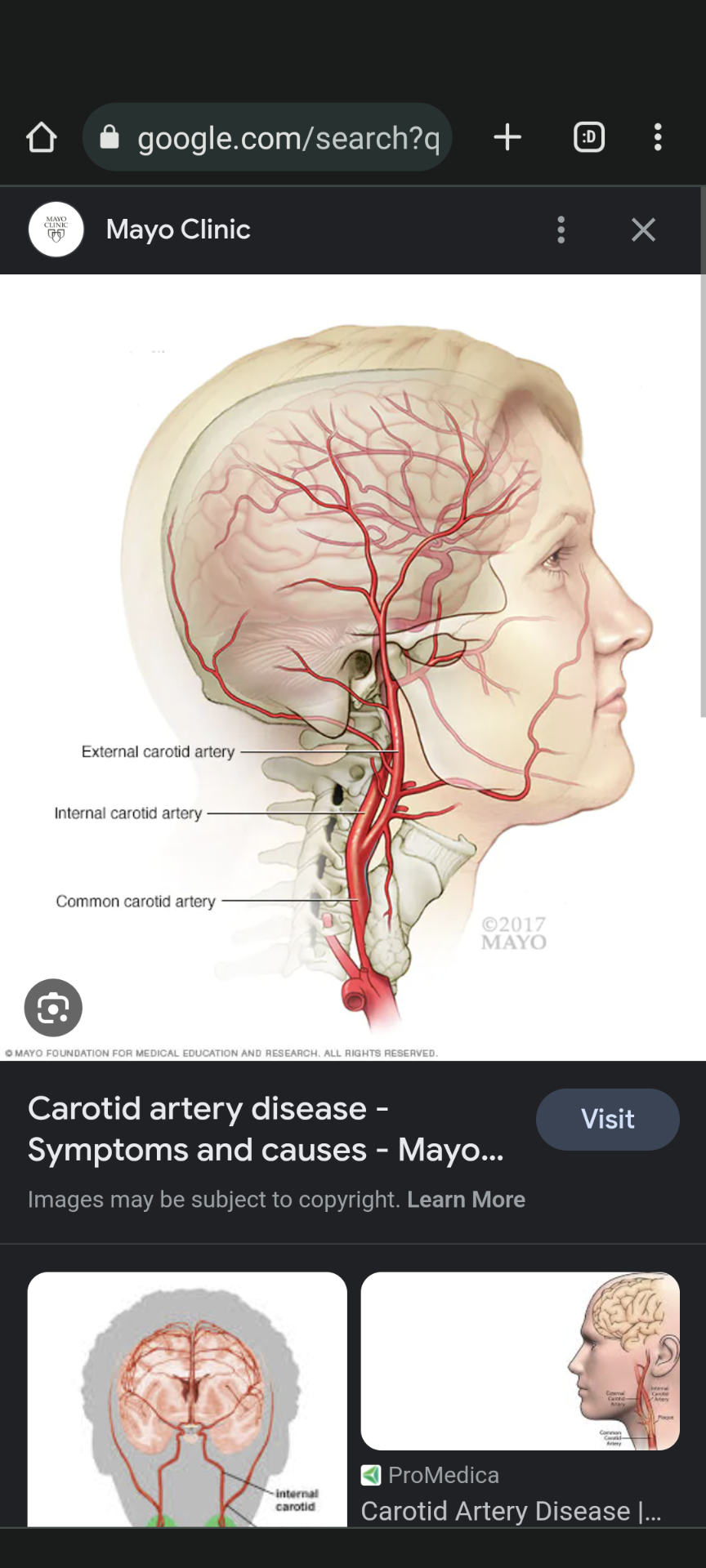 <p></p><ul><li><p>Description: Supply blood to face, neck, and brain.</p></li><li><p>Types: External (face, neck), Internal (brain).</p></li></ul>