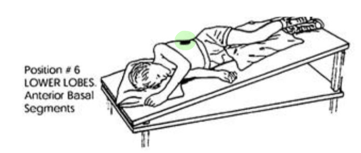 <ul><li><p>R or L Side Lying with Head Down 30 deg </p></li></ul><p></p>