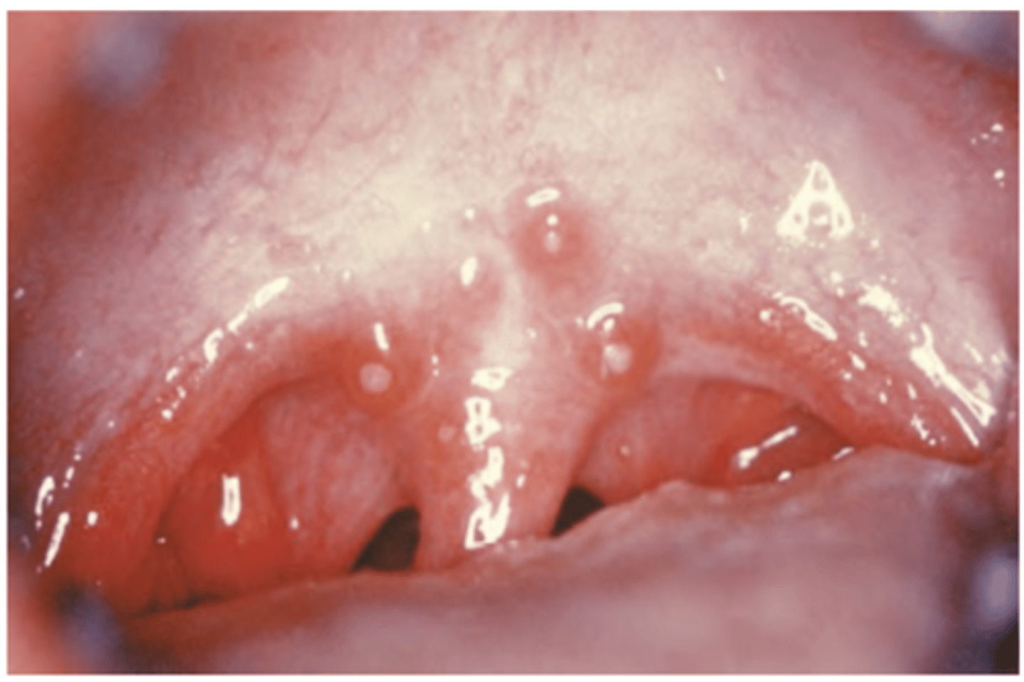 <p>Hint: few (1-5) yellow to dark-pink nodules develop on soft palate or tonsillar pillars that resolve within 10 days</p>