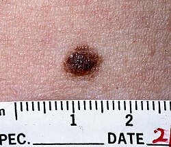 <p>mole/freckle</p><p>benign</p><p>symmetric/evenly-pigmented macule/papule</p><p>new nevi after 30 minutes in sun→suspicious</p><p><u>blue nevus:</u> melanocytes in dermis</p><p><u>becker’s nevus:</u><br>present at birth<br>appear with puberty<br>males</p>