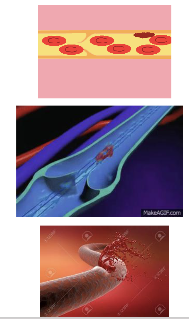 <ul><li><p><strong>Thrombus:</strong> a <strong>blood</strong> <strong>clot</strong> <strong>forms</strong> in an <strong>unbroken</strong> <strong>blood</strong> <strong>vessel</strong>, which can potentially <strong>obstruct</strong> <strong>blood</strong> <strong>flow</strong></p></li><li><p><strong>Embolus:</strong> a <strong>detached</strong> <strong>mass</strong> that <strong>flows</strong> <strong>through</strong> the <strong>blood</strong> (ex: thrombus)</p></li><li><p><strong>Hemophilia</strong> (haemophilia): a <strong>genetic</strong> <strong>condition</strong> where <strong>blood</strong> <strong>does</strong> <strong>not</strong> <strong>clot</strong></p></li></ul><p></p>
