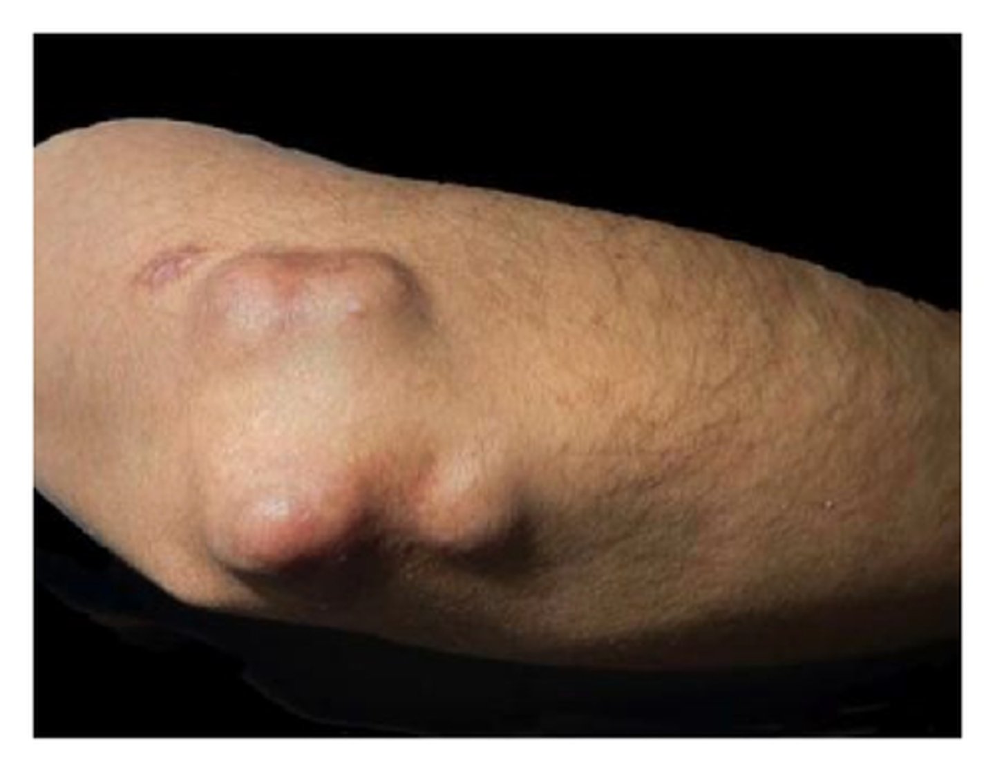 <p>what disease does this picture indicate?</p>