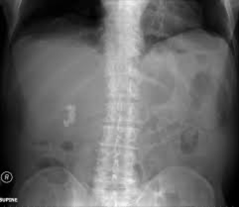 <p>Occurs when bile doesn’t have enough bile salts and lecithin: cholesterol</p><p>Types:</p><p>Cholesterol stone- most common</p><p>Harder to penetrate</p>