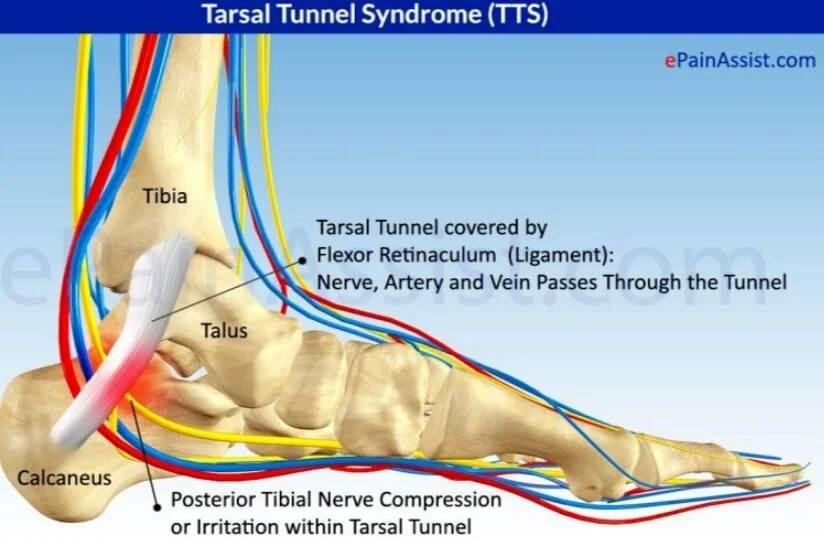 <p>Space behind medial malleolus containing TP, FDL, A./V./N. tibialis posterior, FHL. 🔎 Locate by "Tom Dick ANd Harry" order. 💡 "Tunnel = tight passage."</p>