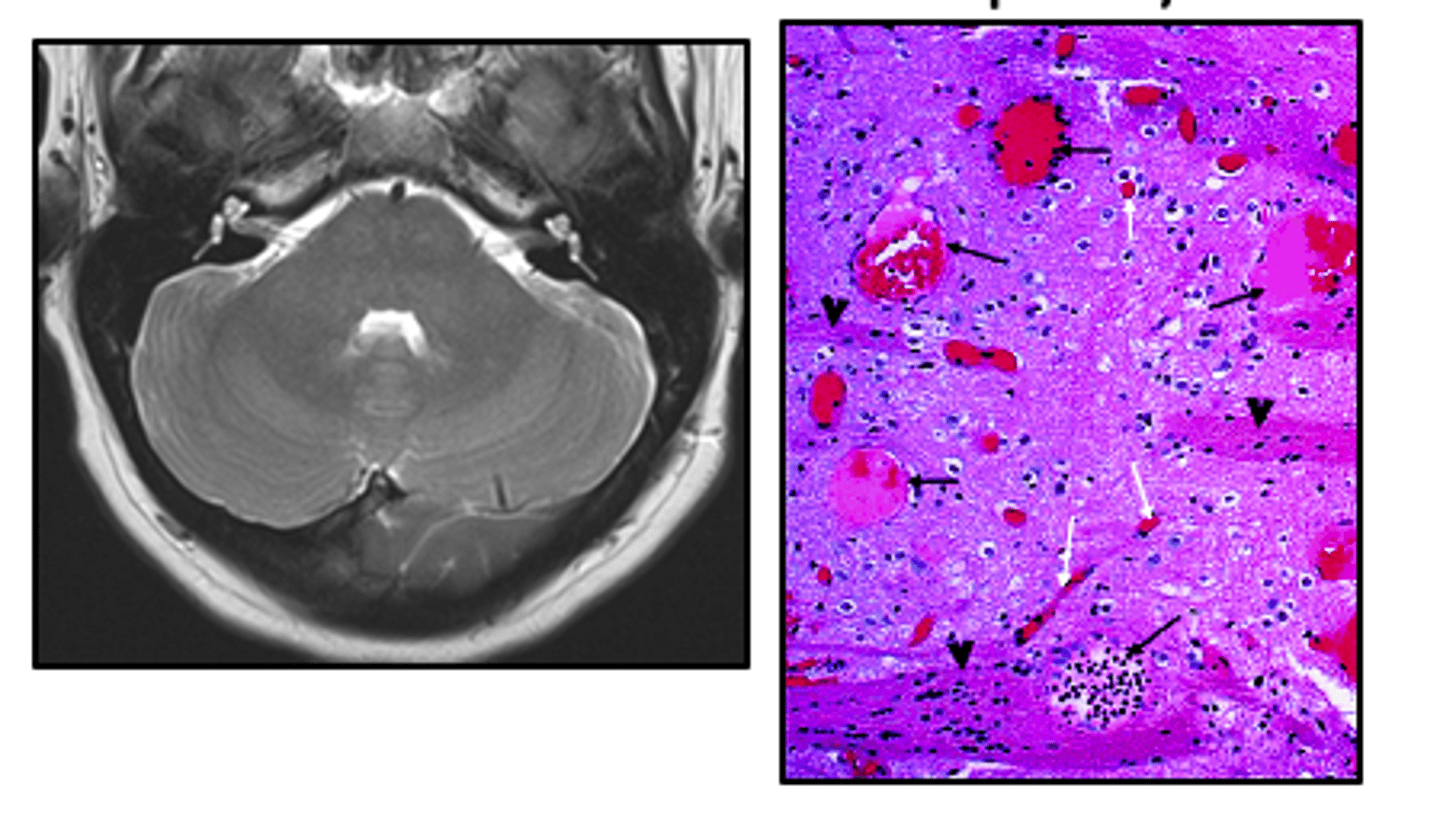 <p>dilated capillaries in brain tissue</p>