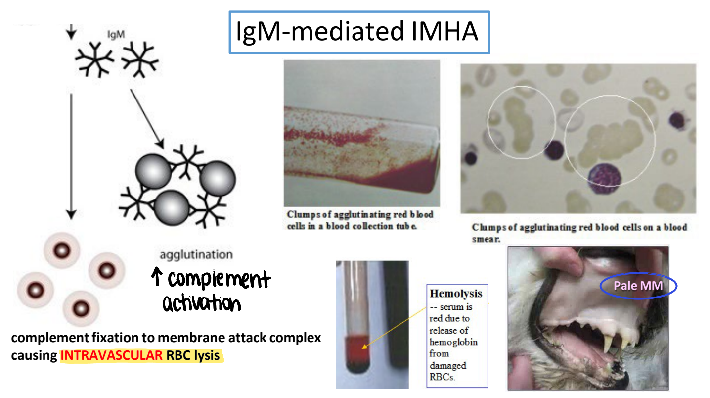 <ul><li><p><strong>pale</strong> MM</p></li><li><p>IgM (large pentamer) → ↑ agglutination → ↑ complement activation &amp; membrane attack complex → <strong>intravascular RBC lysis</strong></p></li></ul><p></p>