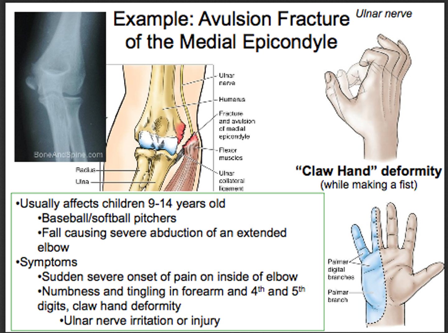 <p>This injury can occur after a fall caused by severe abduction of fully extended forearm</p>