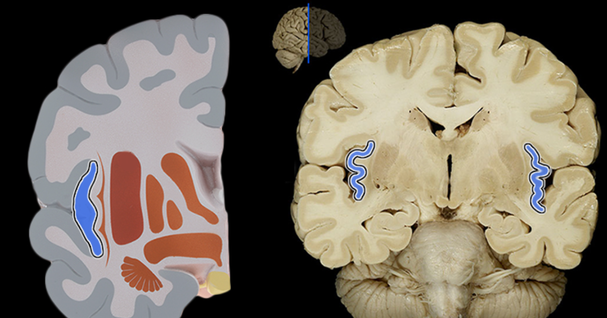 <p>Location:</p><ul><li><p>Deep in each lateral sulcus</p></li></ul><p>Description:</p><ul><li><p>Cerebral lobe</p></li><li><p>Not visible from surface</p></li></ul><p>Function:</p><ul><li><p>Understanding spoken language</p></li><li><p>Perception of taste and smell</p></li><li><p>Integrates information from visceral receptors</p></li></ul><p>Also known as:</p><ul><li><p>Insula or isle of Reil</p></li></ul><p></p>