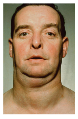 <ul><li><p><span style="background-color: transparent;"><span>swelling of the skin caused by a buildup of </span><u><span>mucin</span></u></span></p></li><li><p><span style="background-color: transparent;"><span>can be caused by </span><u><span>hypothyroidism</span></u></span></p></li><li><p><span style="background-color: transparent;"><span>can lead to myxedema </span><u><span>coma</span></u></span></p></li></ul><p></p>