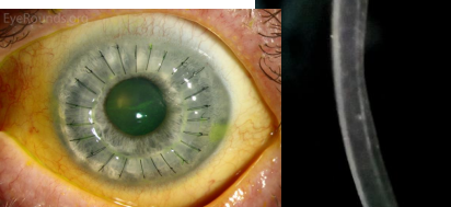 <p>full-thickness corneal transplant (all layers)</p><ul><li><p>endothelial loss begins immediately (drops to 800/ mm2)</p></li><li><p>impacts tolerance to reduced O2 states</p></li></ul>