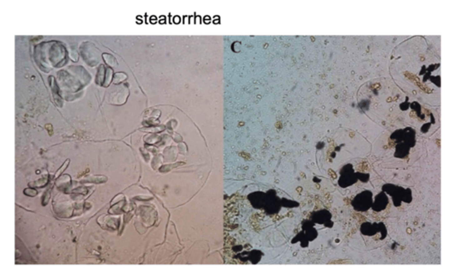 <p>undigested fat in the feces.</p><p>the feces appears yellow and pasty</p>