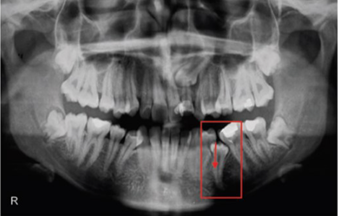 <p>Tooth not at level of occlusion </p>