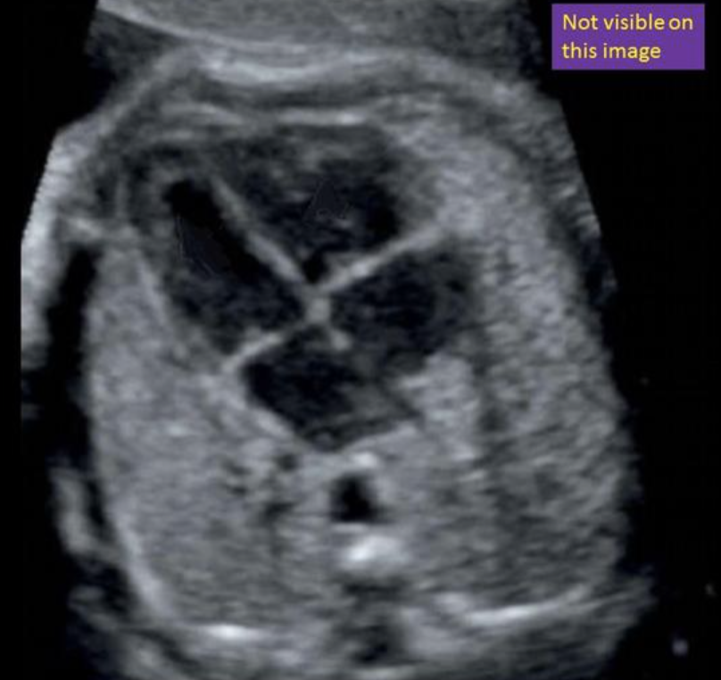 <p>where is the inferior vena cava</p><ul><li><p>“not visible on this image”</p></li><li><p>inferior to right atrium</p></li></ul><p></p>