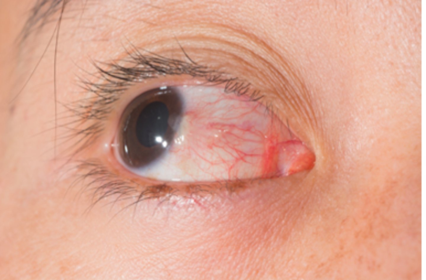 <p>Significant eye pain, irritation, foreign body sensation, and photophobia are common due to the dense corneal innervation by the trigeminal nerve. Vision impairment may also occur if the abrasion is large or overlaps the visual field.</p>