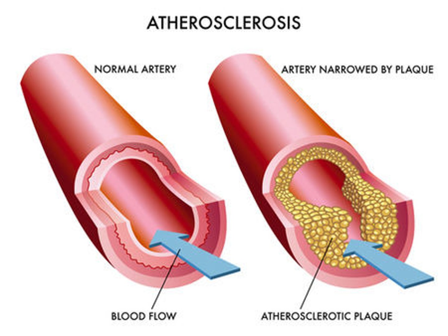<p>condition in which fatty deposits called plaque buildup on the inner walls of the arteries.</p><p>Athero - pasty material / plaque</p><p>Sclerosis - hardening</p>