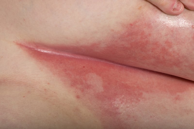 <p>superficial skin inflammation in skin folds due to heat/friction/moisture that breaks down skin’s protective barrier that leads to signs and of: </p><ol><li><p>erythema (redness) </p></li><li><p>maceration (softening of the skin) </p></li><li><p>potential secondary infections (fungi like candida) </p><p></p></li></ol><p></p>