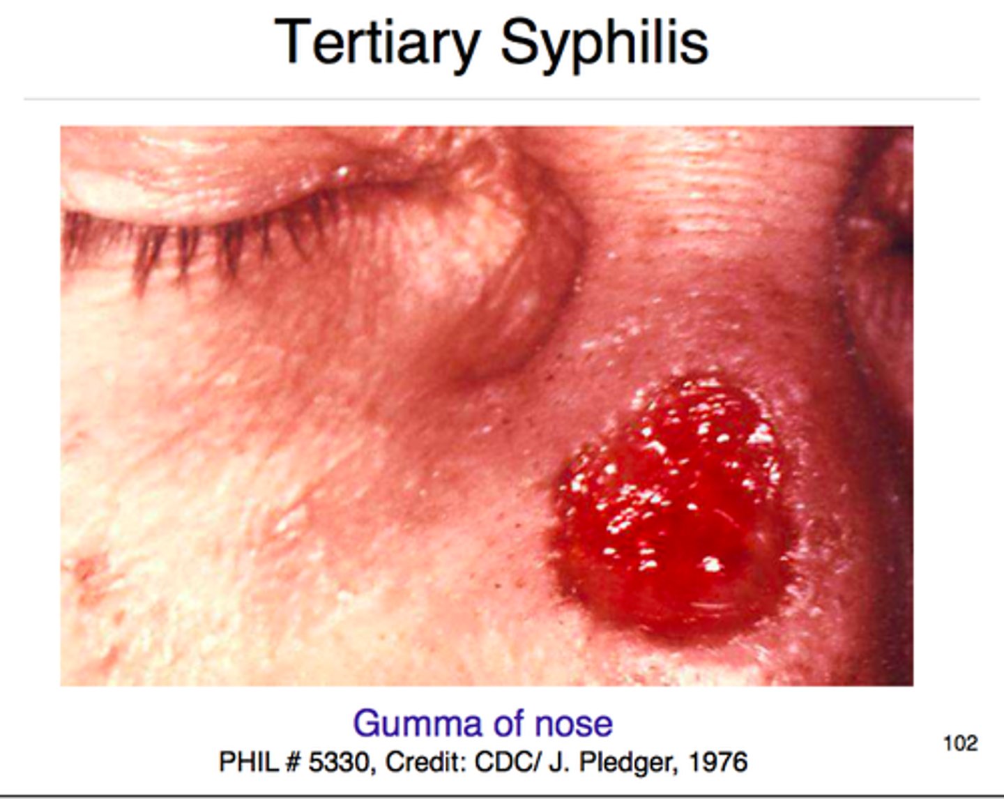 <p>-tabes dorsalis</p><p>-argyll-roberson pupils</p><p>-gummas</p><p>-can present as meningitis</p>