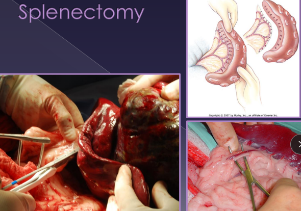 <ul><li><p><strong>FNA:</strong> percutaneous, cheap, easy</p><ul><li><p><strong><u>concern for diffuse dz</u></strong>, avoid cavitary lesions</p><ul><li><p>Ddx: infection, mast cell, lymphoma </p></li><li><p><u>non-diagnostic for neoplastic masses (blood back)</u></p></li></ul></li></ul></li></ul><ul><li><p><strong>Excisional Biopsy:</strong> diffuse dx, small/focal mass, <u>culture</u>, histopath</p><ul><li><p>Sx incision → sample → capsule sutured closed, direct pressure hemostasis</p><ul><li><p><span style="color: red;">NOT really done, just remove the entire thing at once</span></p></li></ul></li></ul></li><li><p><strong>Splenectomy:</strong> Neoplasia, trauma, IM dz</p><ul><li><p><span style="color: rgb(136, 136, 136);"><strong>Classic:</strong></span> dissect &<strong> ligate/divide all hilar vessels</strong>; <u>protect short gastric a.</u></p></li><li><p><span style="color: rgb(136, 136, 136);"><strong>Alternate:</strong></span><strong> Abdominal exploration, </strong>isolate, <strong>ligate splenic a. & v. <u>distal</u> to pancreatic branch/short gastric aa. / L gastroepiploic</strong></p><ul><li><p>quicker, best for no adhesions</p></li></ul></li><li><p><strong><u>Complications</u></strong>: </p><ul><li><p>Hemorrhage</p></li><li><p>Resist this temptation to break down adhesions</p></li></ul></li></ul></li></ul><p></p>