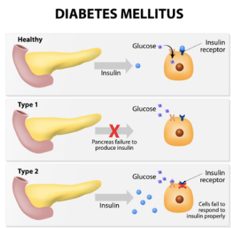 <p>Diabetes Mellitus</p>