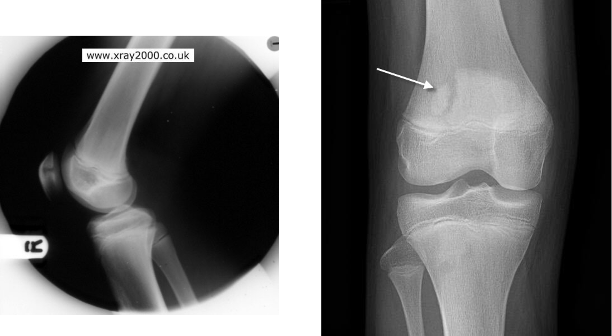 <p>normal variant that may appear to be a fx</p><p>forms when portion of patella does not completely heal along bony edges of patella </p>